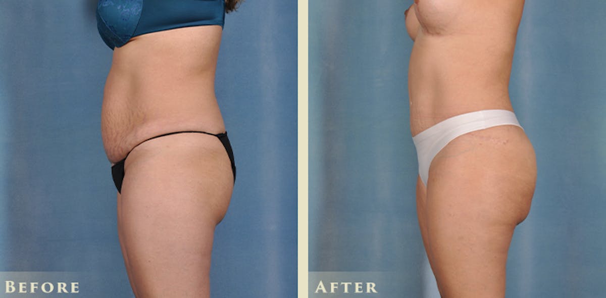 Brazilian Butt Lift Before & After Gallery - Patient 394624 - Image 1