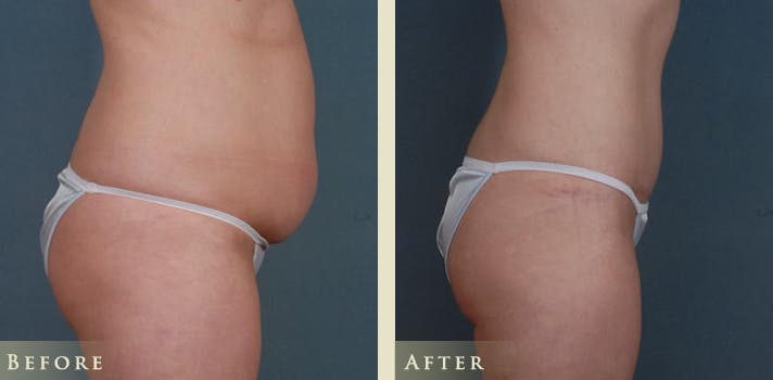 Tummy Tuck Before & After Gallery - Patient 137691 - Image 3