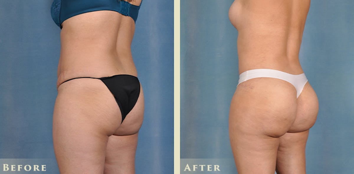 Brazilian Butt Lift Before & After Gallery - Patient 394624 - Image 2