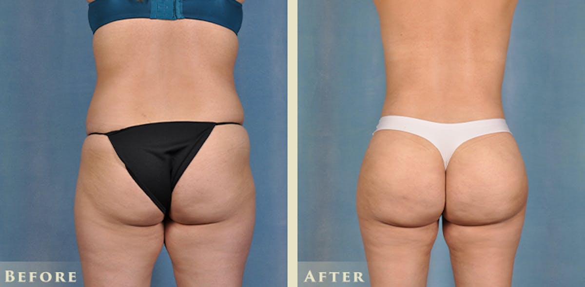 Brazilian Butt Lift Before & After Gallery - Patient 394624 - Image 3