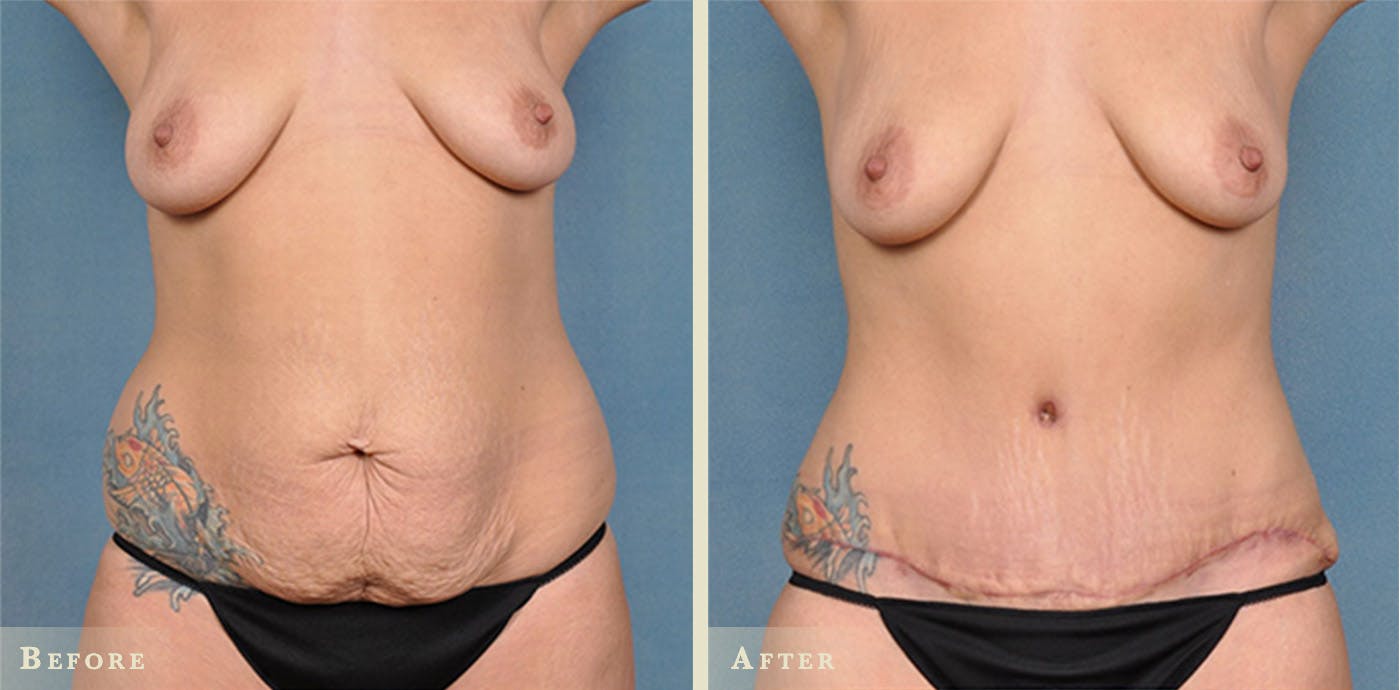 Tummy Tuck Before & After Gallery - Patient 390930 - Image 1