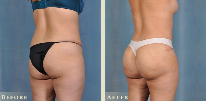Brazilian Butt Lift Before & After Gallery - Patient 394624 - Image 4