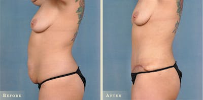 Tummy Tuck Before & After Gallery - Patient 390930 - Image 2