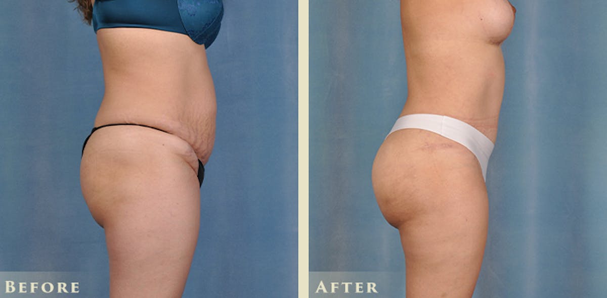 Brazilian Butt Lift Before & After Gallery - Patient 394624 - Image 5