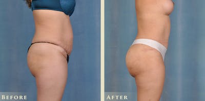 Brazilian Butt Lift Before & After Gallery - Patient 394624 - Image 5