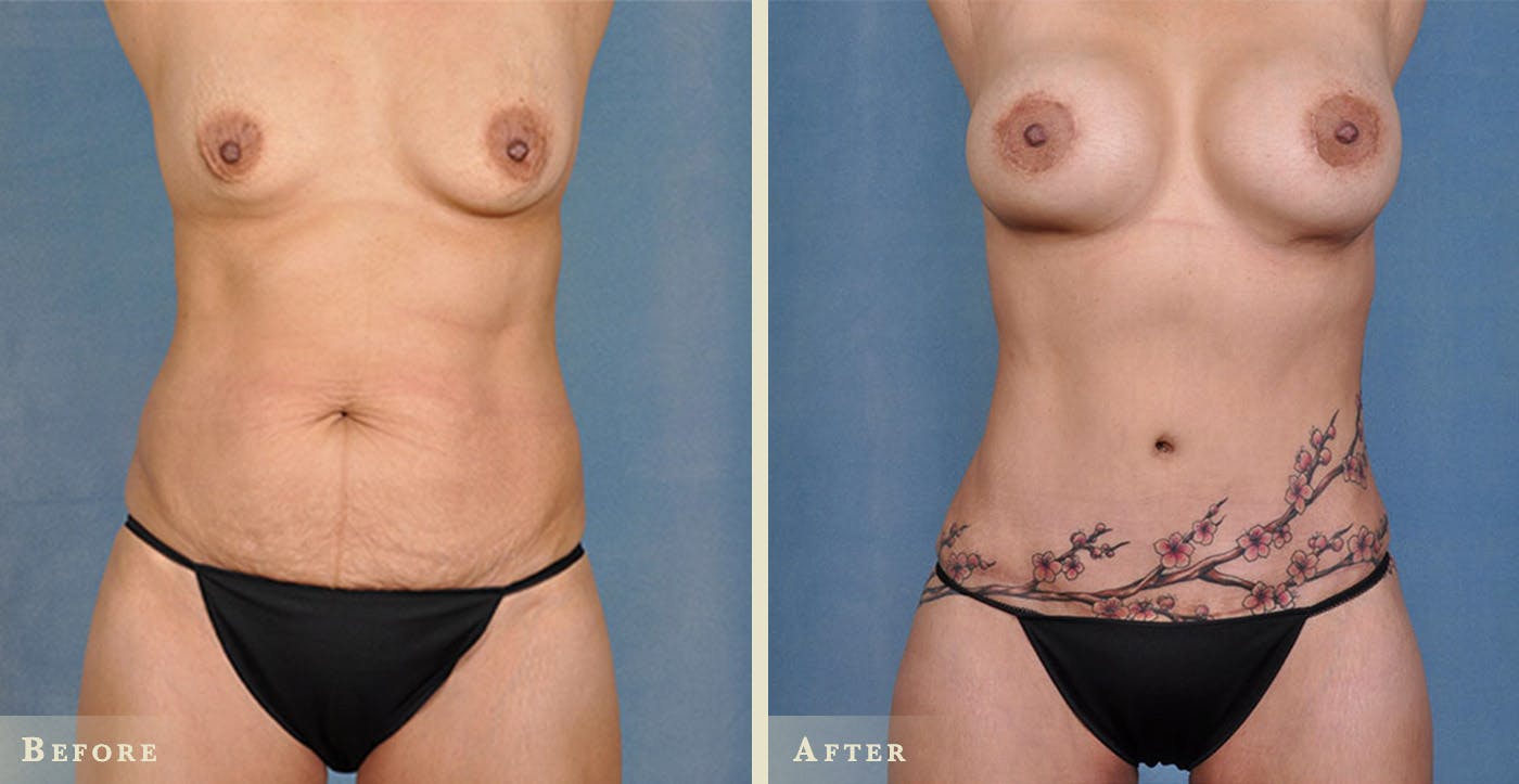 Tummy Tuck Before & After Gallery - Patient 219302 - Image 1
