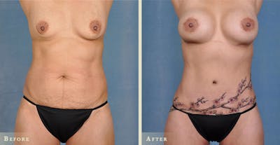 Tummy Tuck Before & After Gallery - Patient 219302 - Image 1