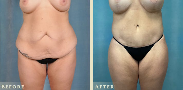Female Liposuction Before & After Gallery - Patient 124352 - Image 1