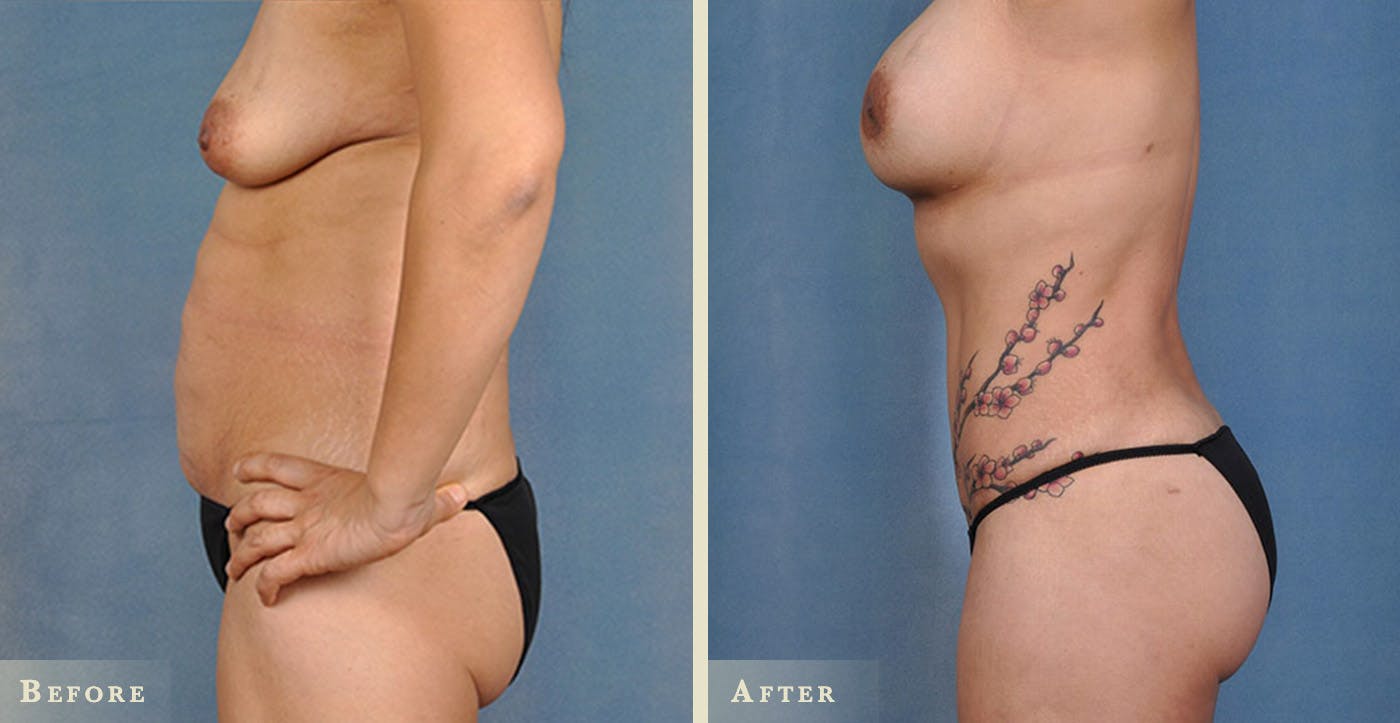 Tummy Tuck Before & After Gallery - Patient 219302 - Image 2