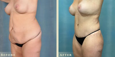 Brazilian Butt Lift Before & After Gallery - Patient 885305 - Image 2