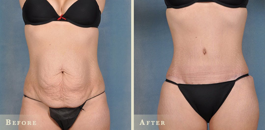 Tummy Tuck Before & After Gallery - Patient 127681 - Image 1