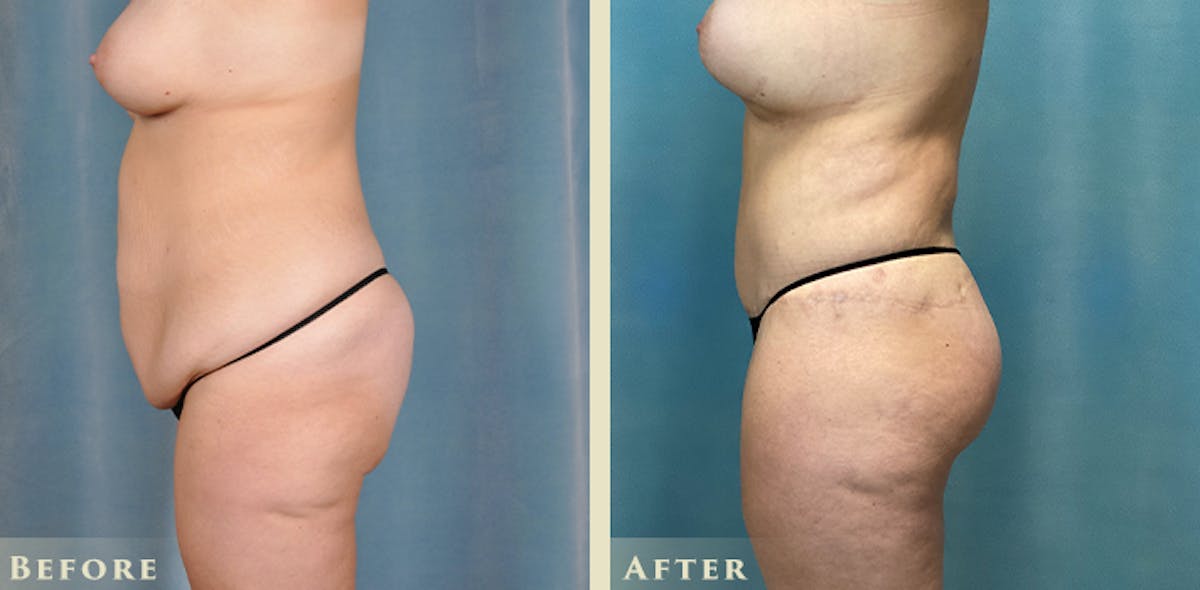 Brazilian Butt Lift Before & After Gallery - Patient 885305 - Image 3