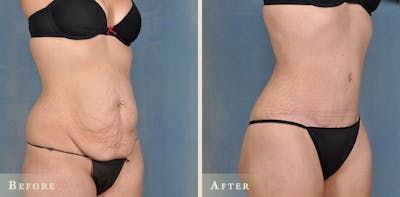 Tummy Tuck Before & After Gallery - Patient 127681 - Image 2