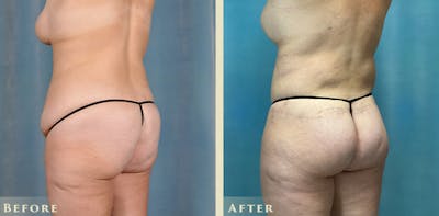 Female Liposuction Before & After Gallery - Patient 124352 - Image 4