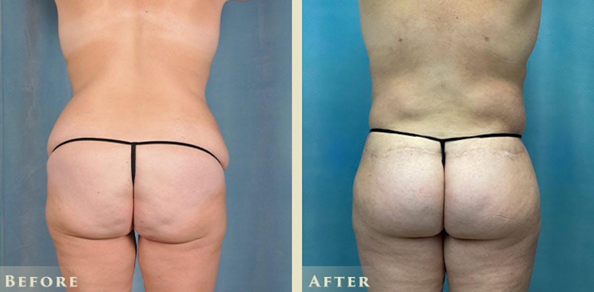 Brazilian Butt Lift Before & After Gallery - Patient 885305 - Image 5