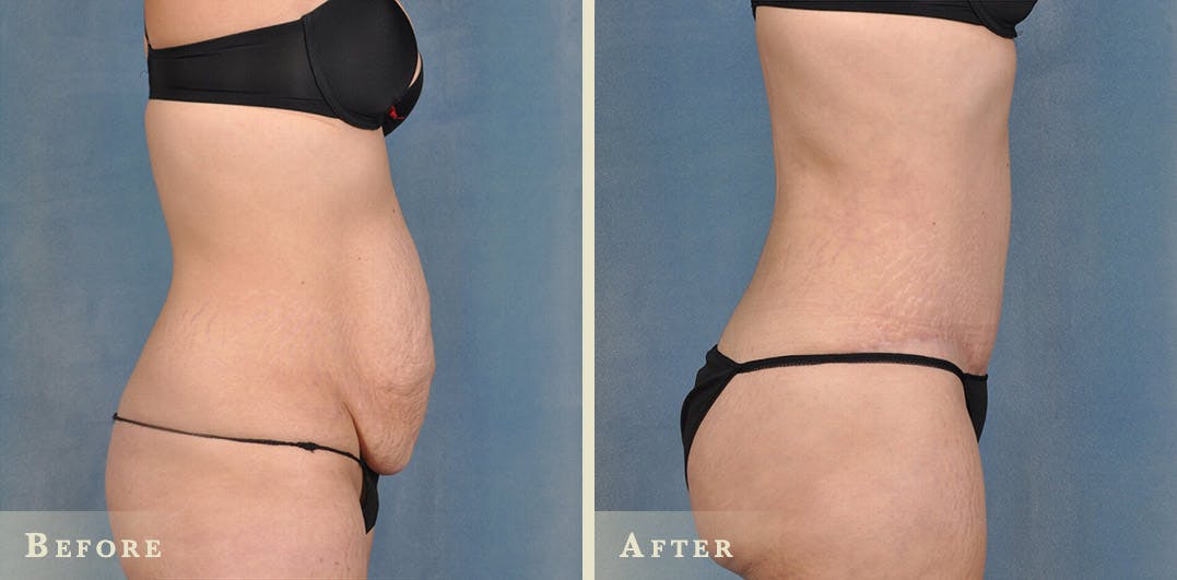 Tummy Tuck Before & After Gallery - Patient 127681 - Image 3