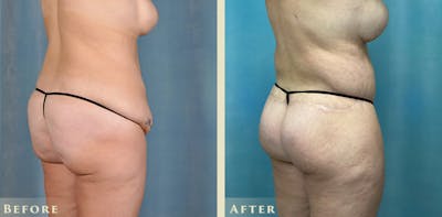 Brazilian Butt Lift Before & After Gallery - Patient 885305 - Image 6
