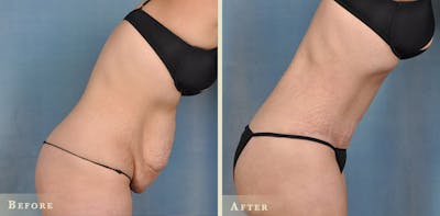 Tummy Tuck Before & After Gallery - Patient 127681 - Image 4