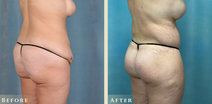 Female Liposuction Before & After Gallery - Patient 124352 - Image 6