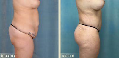 Brazilian Butt Lift Before & After Gallery - Patient 885305 - Image 7