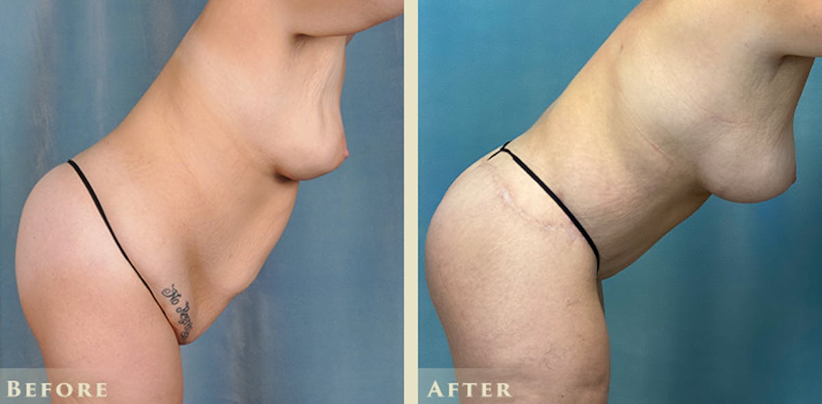 Brazilian Butt Lift Before & After Gallery - Patient 885305 - Image 8