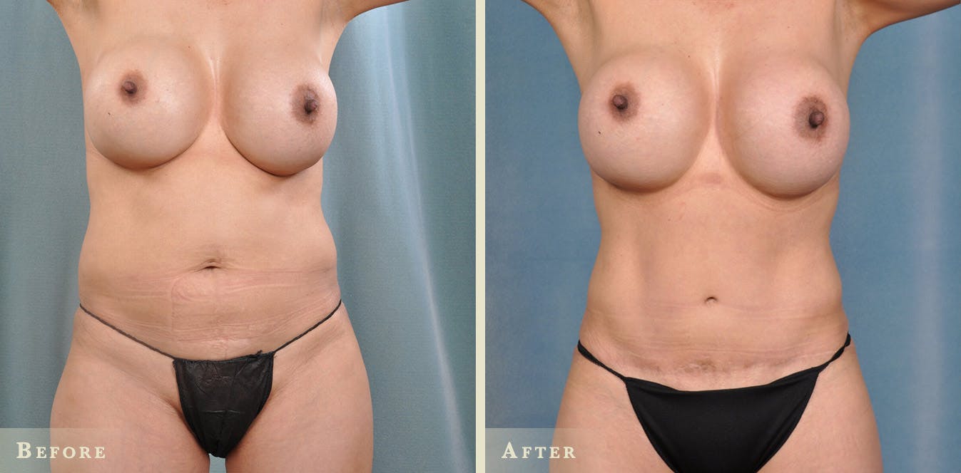 Tummy Tuck Before & After Gallery - Patient 237616 - Image 1