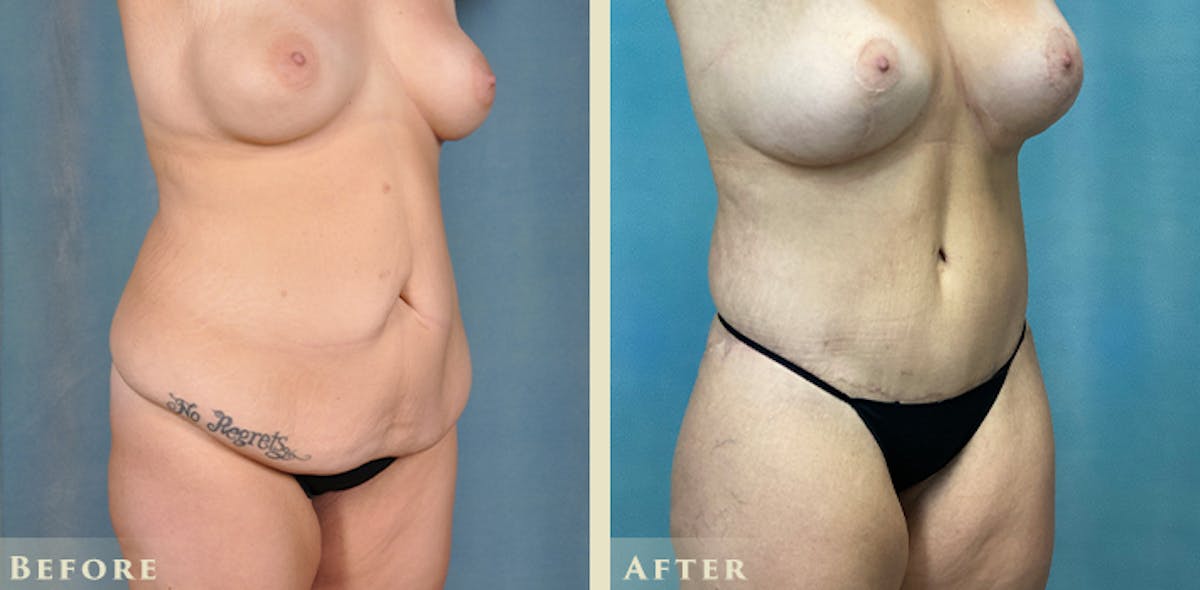 Female Liposuction Before & After Gallery - Patient 124352 - Image 9