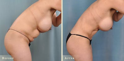 Tummy Tuck Before & After Gallery - Patient 237616 - Image 6