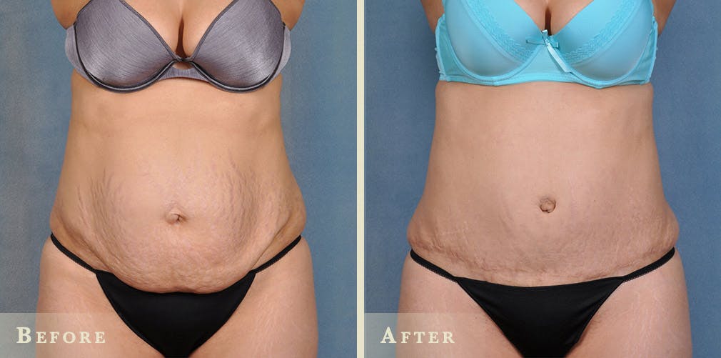 Tummy Tuck Before & After Gallery - Patient 158362 - Image 1