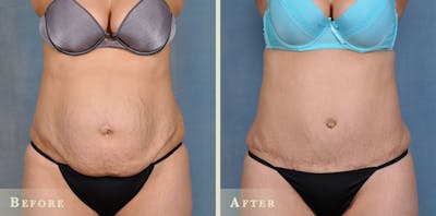 Tummy Tuck Before & After Gallery - Patient 158362 - Image 1