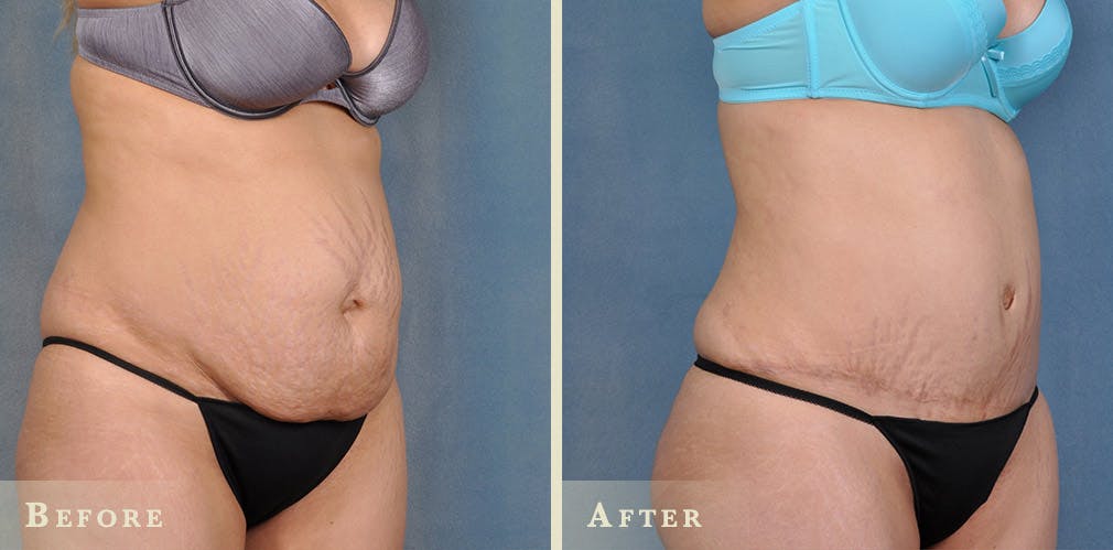 Tummy Tuck Before & After Gallery - Patient 158362 - Image 2