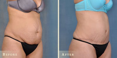 Tummy Tuck Before & After Gallery - Patient 158362 - Image 2