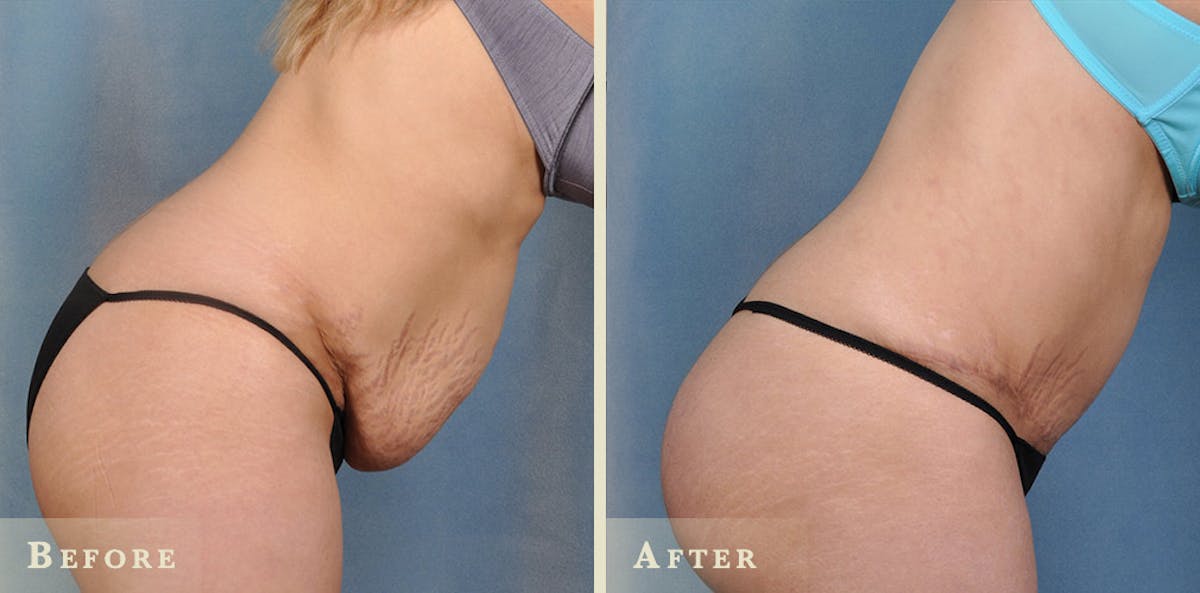 Tummy Tuck Before & After Gallery - Patient 158362 - Image 4