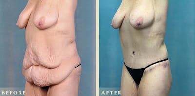 Tummy Tuck Before & After Gallery - Patient 295703 - Image 2