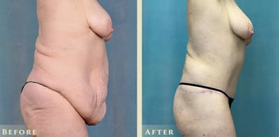 Tummy Tuck Before & After Gallery - Patient 295703 - Image 5