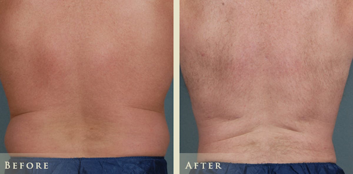 Male Liposuction Before & After Gallery - Patient 222299 - Image 1