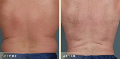 Male Liposuction Before & After Gallery - Patient 222299 - Image 1