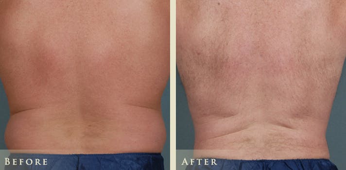 Male Liposuction Before & After Gallery - Patient 222299 - Image 1