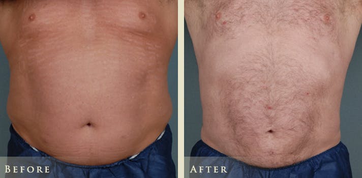 Male Liposuction Before & After Gallery - Patient 222299 - Image 2