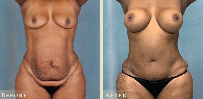 Tummy Tuck Before & After Gallery - Patient 405663 - Image 1