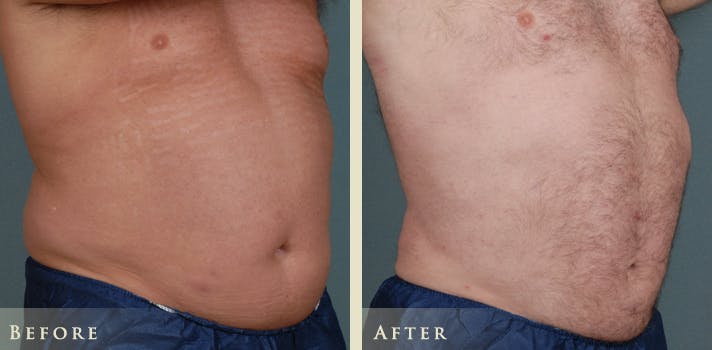 Male Liposuction Before & After Gallery - Patient 222299 - Image 3