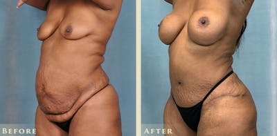 Tummy Tuck Before & After Gallery - Patient 405663 - Image 2