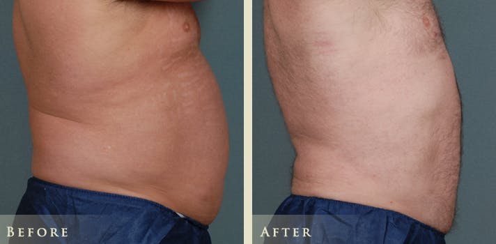 Male Liposuction Before & After Gallery - Patient 222299 - Image 4