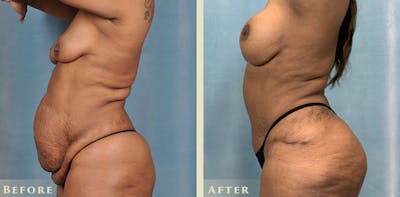 Tummy Tuck Before & After Gallery - Patient 405663 - Image 3