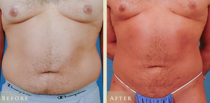 Male Liposuction Before & After Gallery - Patient 178919 - Image 1
