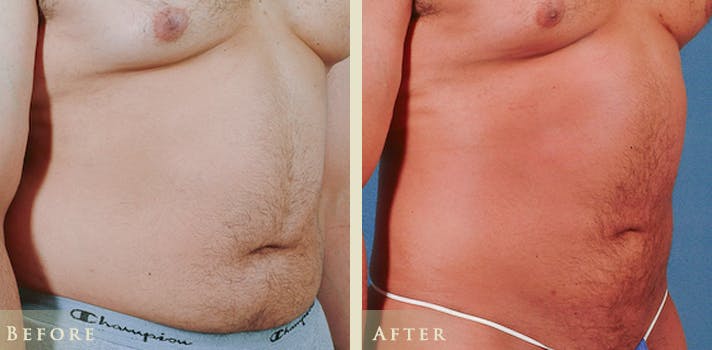 Male Liposuction Before & After Gallery - Patient 178919 - Image 2