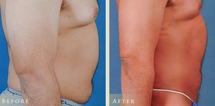 Male Liposuction Before & After Gallery - Patient 178919 - Image 3