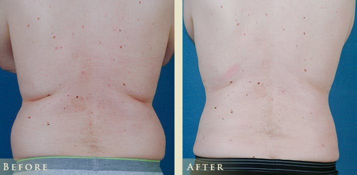 Male Liposuction Before & After Gallery - Patient 363835 - Image 1