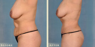 Tummy Tuck Before & After Gallery - Patient 246163 - Image 3