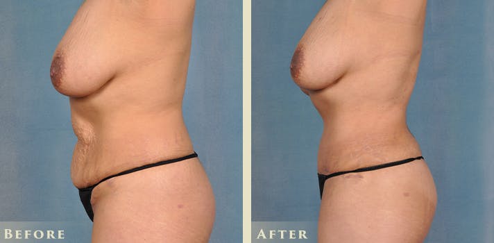 Tummy Tuck Before & After Gallery - Patient 246163 - Image 3